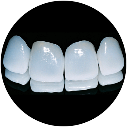 Com o uso das facetas de porcelana dental o sorriso se renova com tecnologia e rapidez.